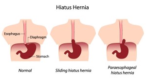 hiatal hernia types