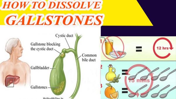 7 Juices that Dissolve Gallstones Naturally ! how to dissolve Gallstone