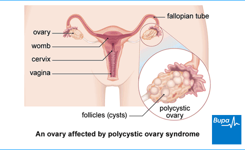 PCOS affected