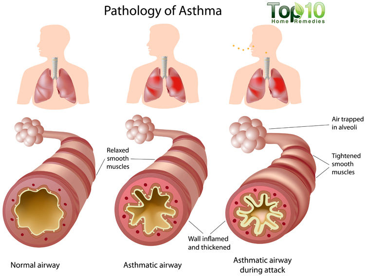 Asthma ka ilaj