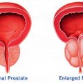 prostate ka ilaj, प्रोस्टेट का इलाज