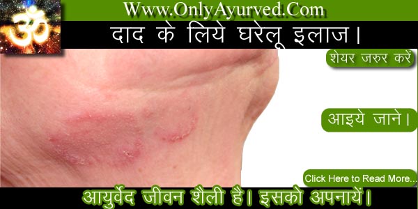 eczema treatment in hindi