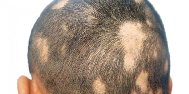 alopecia ka ilaj