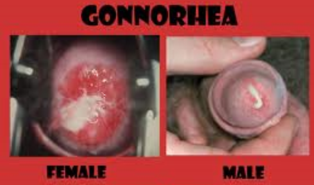 gonorrhoea