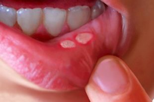 mouth ulcer