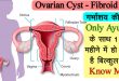 गर्भाशय की गांठ, stri sanjivani, ovarian cyst ka ilaj, गर्भाशय की गाँठ