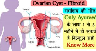 गर्भाशय की गांठ, stri sanjivani, ovarian cyst ka ilaj, गर्भाशय की गाँठ